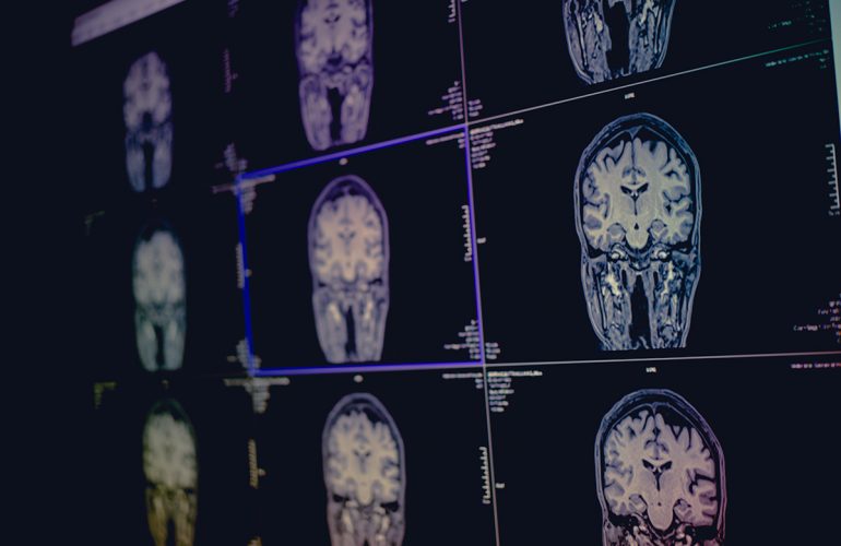 Vascular Dementia: A Quick Review